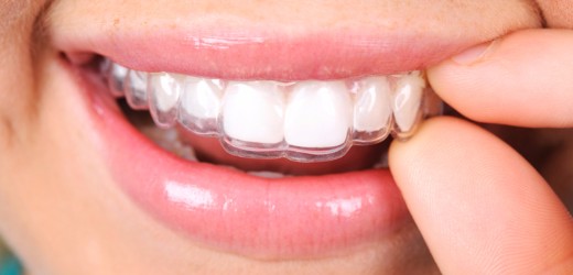Invisalign Benefits, Delta Dentist