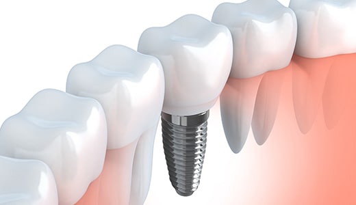 Dental Implants, Delta Surrey Dentist