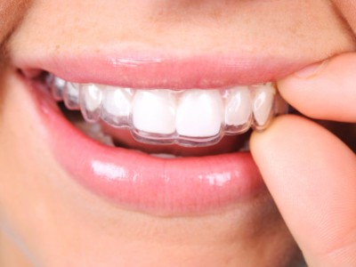 Invisalign Clear Aligners, Delta Dentist